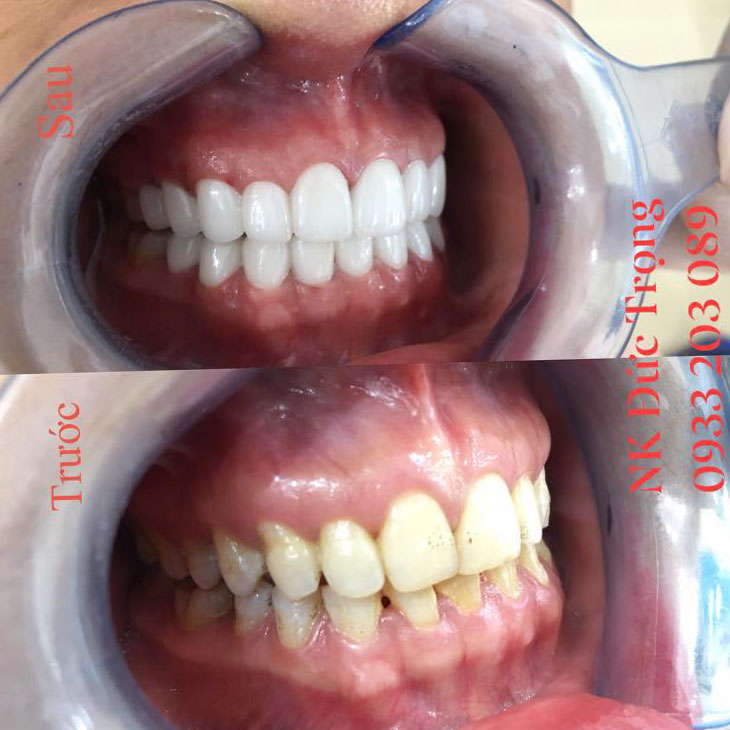 Bọc răng sứ có tốt không? bọc răng sứ tại núi đèo thủy nguyên