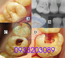 Hàn răng sâu siêu bền siêu chắc tại thủy nguyên hải phòng