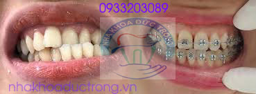 Địa chỉ niềng răng chỉnh nha tốt nhất ở Núi Đèo Thủy Nguyên