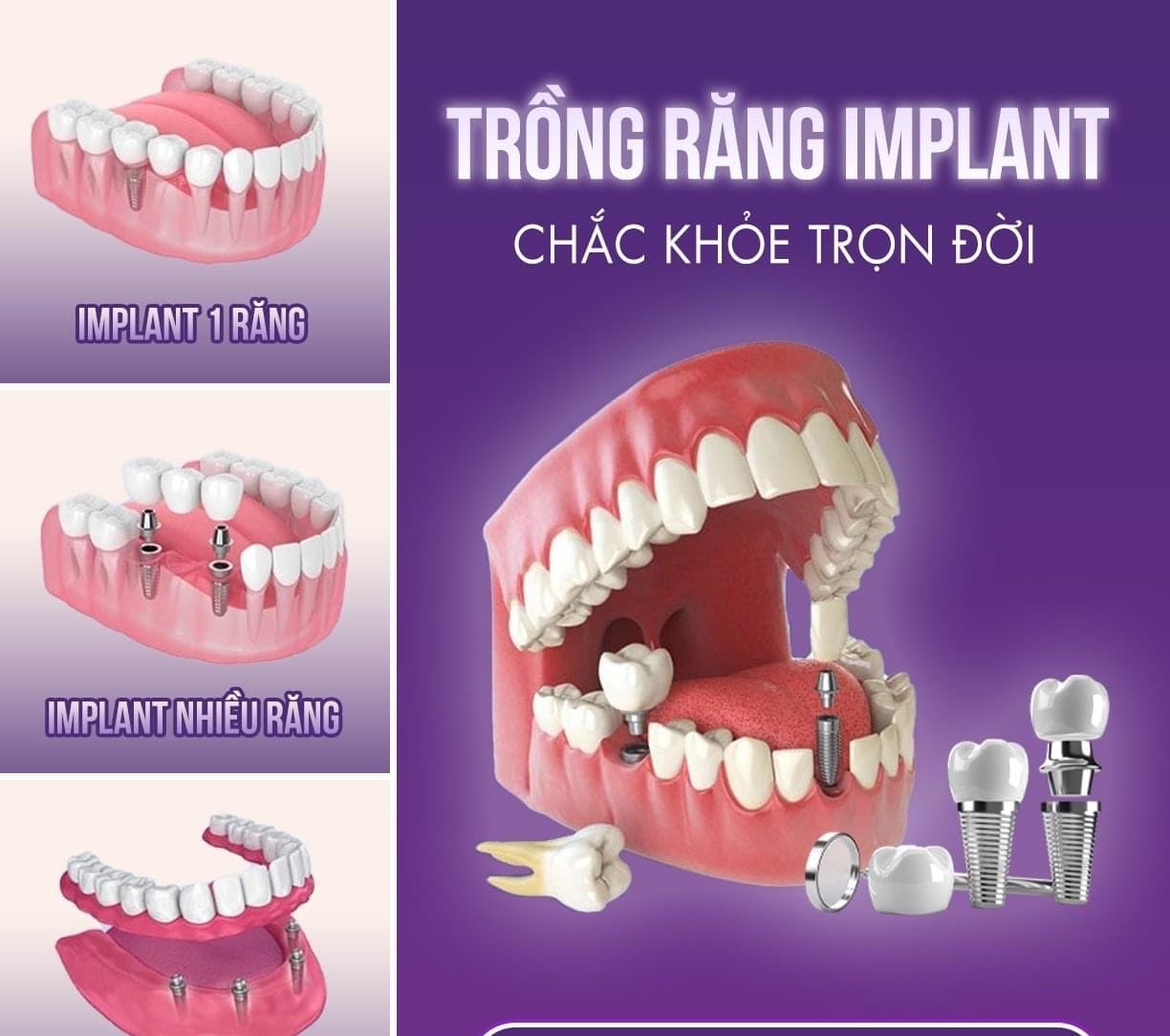 Dấu hiệu bạn lên cấy răng implant