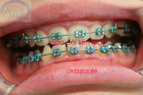 Niềng răng với mắc cài kim loại ( truyền thống )