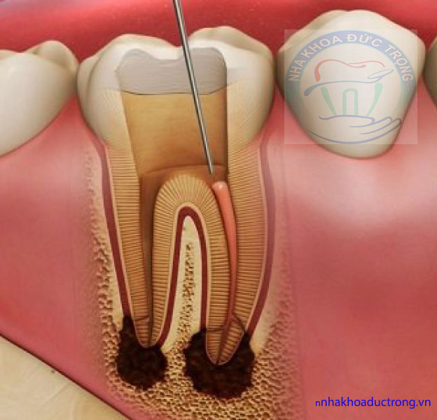 Dấu hiệu của viêm tủy răng? điều trị tủy răng ở Thủy Nguyên