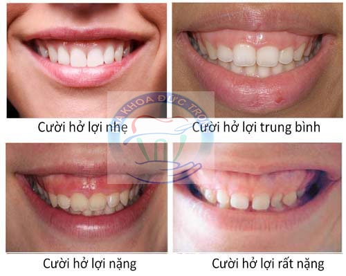Chữa cười hở lợi, dịch vụ ở Thủy Nguyên
