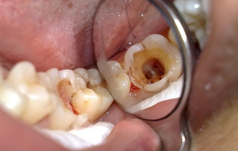 Bị sâu răng nên bọc răng sứ hay trám răng? dịch vụ trám răng tại thủy nguyên hải phòng