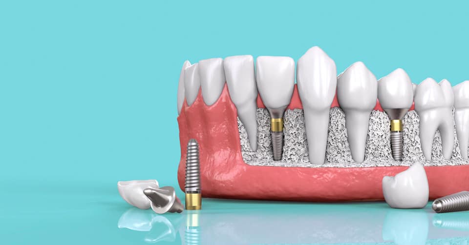 Những lợi ích khi cấy ghép răng Implant - Cấy ghép Implant ở Núi Đèo Thủy Nguyên