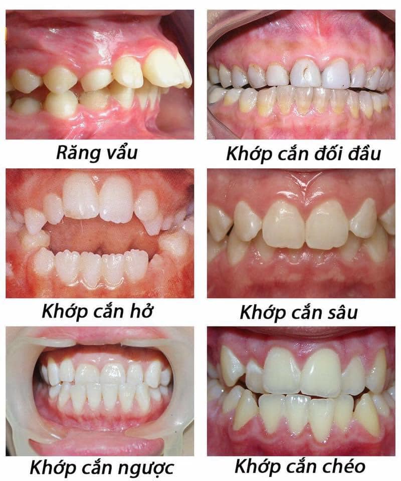 Sai Lệch Khớp Cắn Do Đâu!