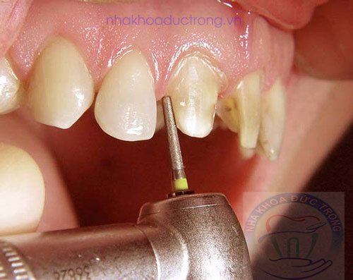 Bọc răng sứ có uy tín tại núi đèo thủy nguyên